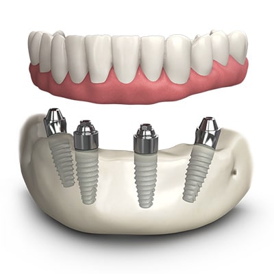 All-on-4 Implants Church Stretton | Replace Missing Teeth