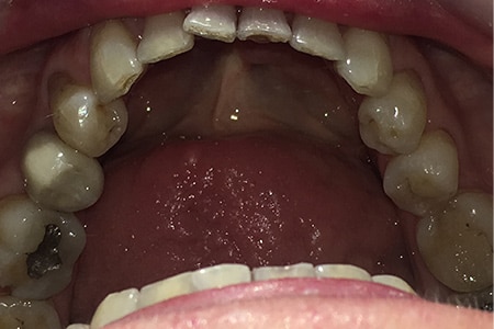IMG_0298 Dental Implants