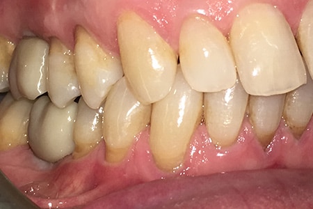 IMG_4429 Dental Implants