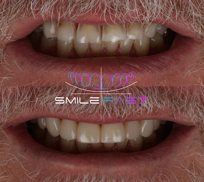 Before After Example 1