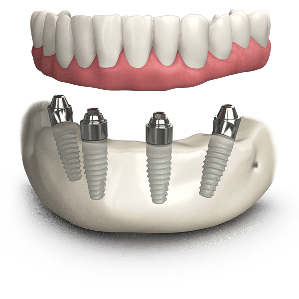 dental-implants-reading